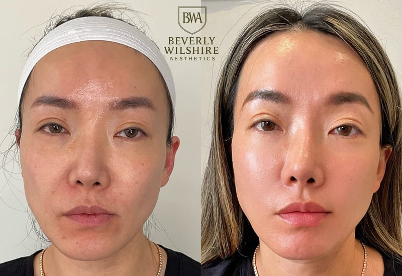Client of Beverly Wilshire Aesthetics featured before and after work over the course of 12 months of Supreme Skin™ treatments to reveal her fully Ascended Skin.