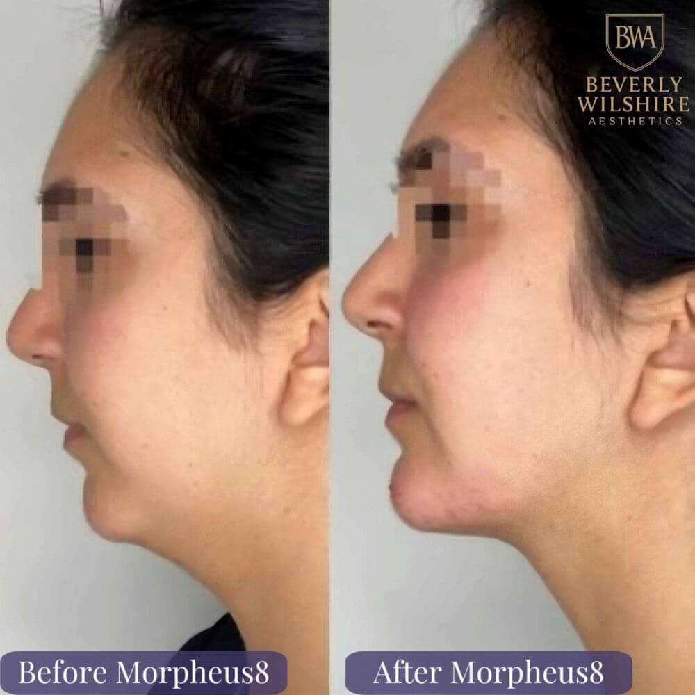 Chin filler paired with Morpheus8 before and after skin tightening Beverly Hills