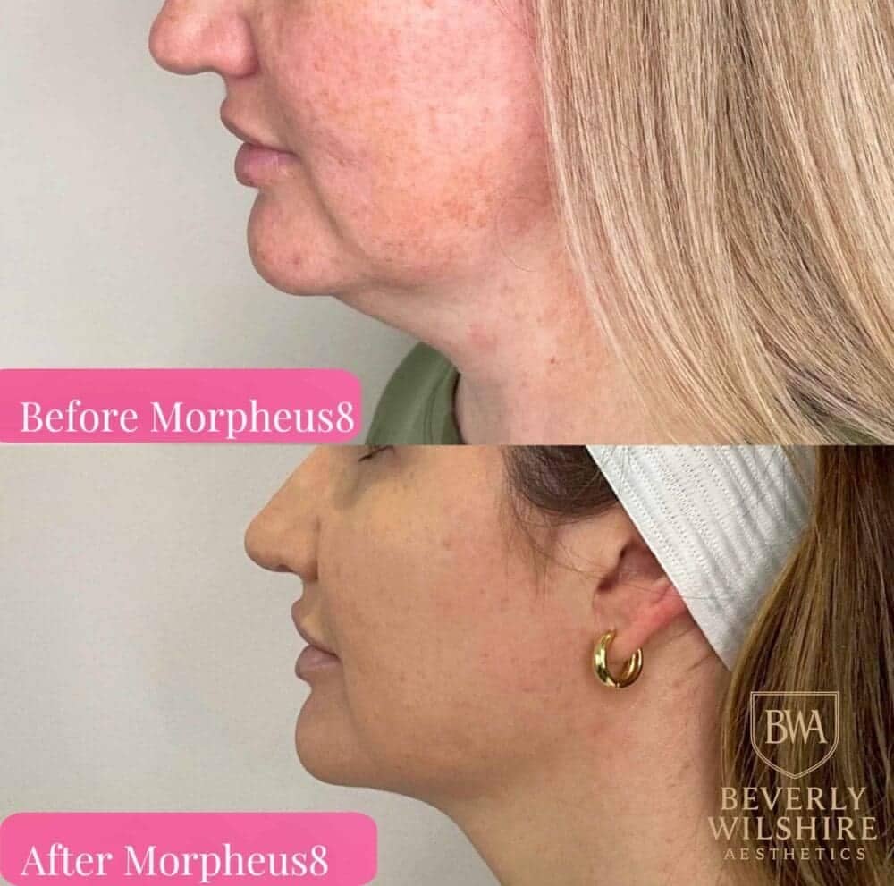 Morpheus8 before and after skin tightening Beverly Hills