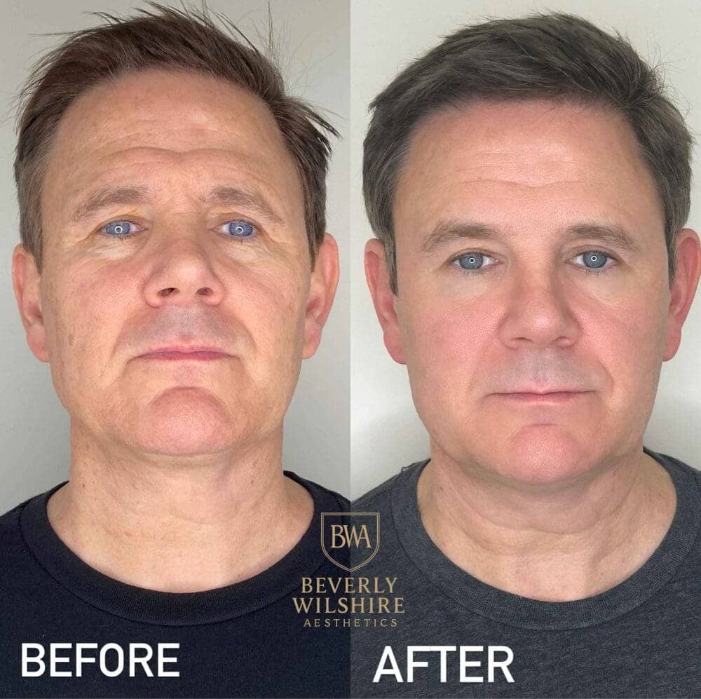 Morpheus8 Beverly Hills Skin Tightening results before and after