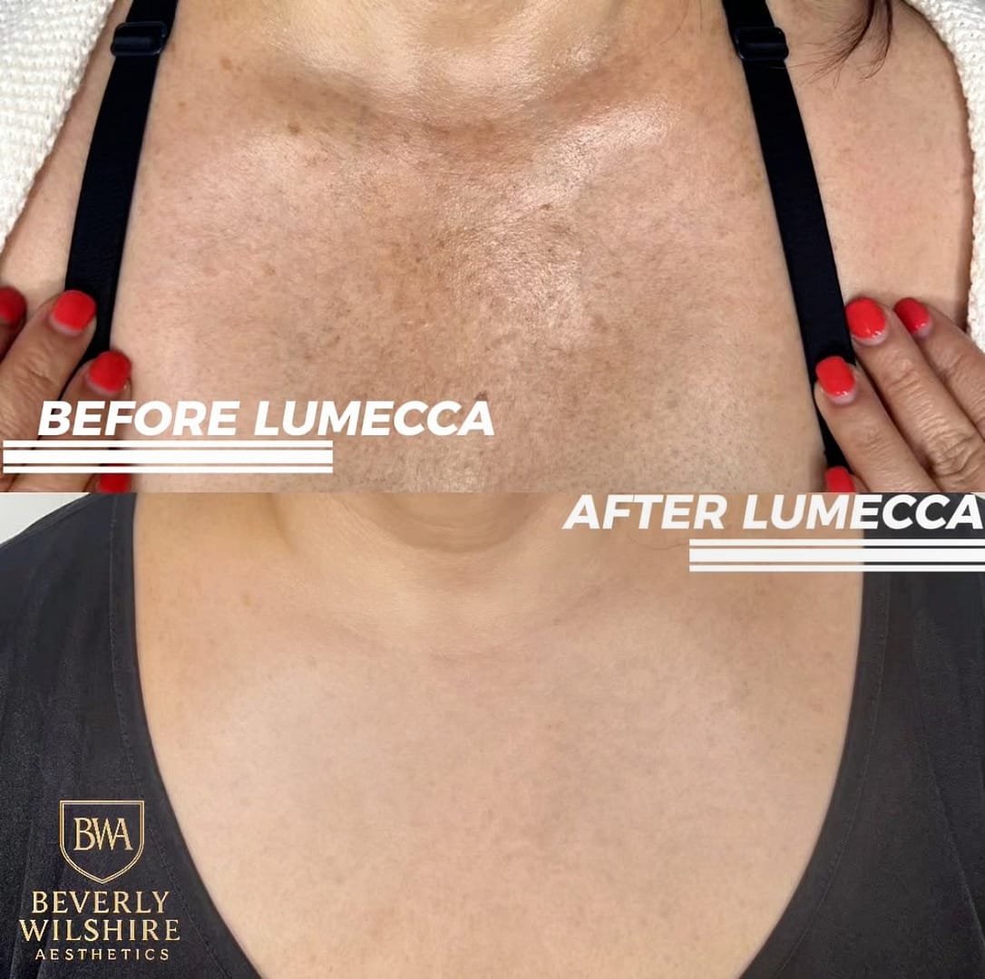 Lumecca before and after results on chest for IPL therapy