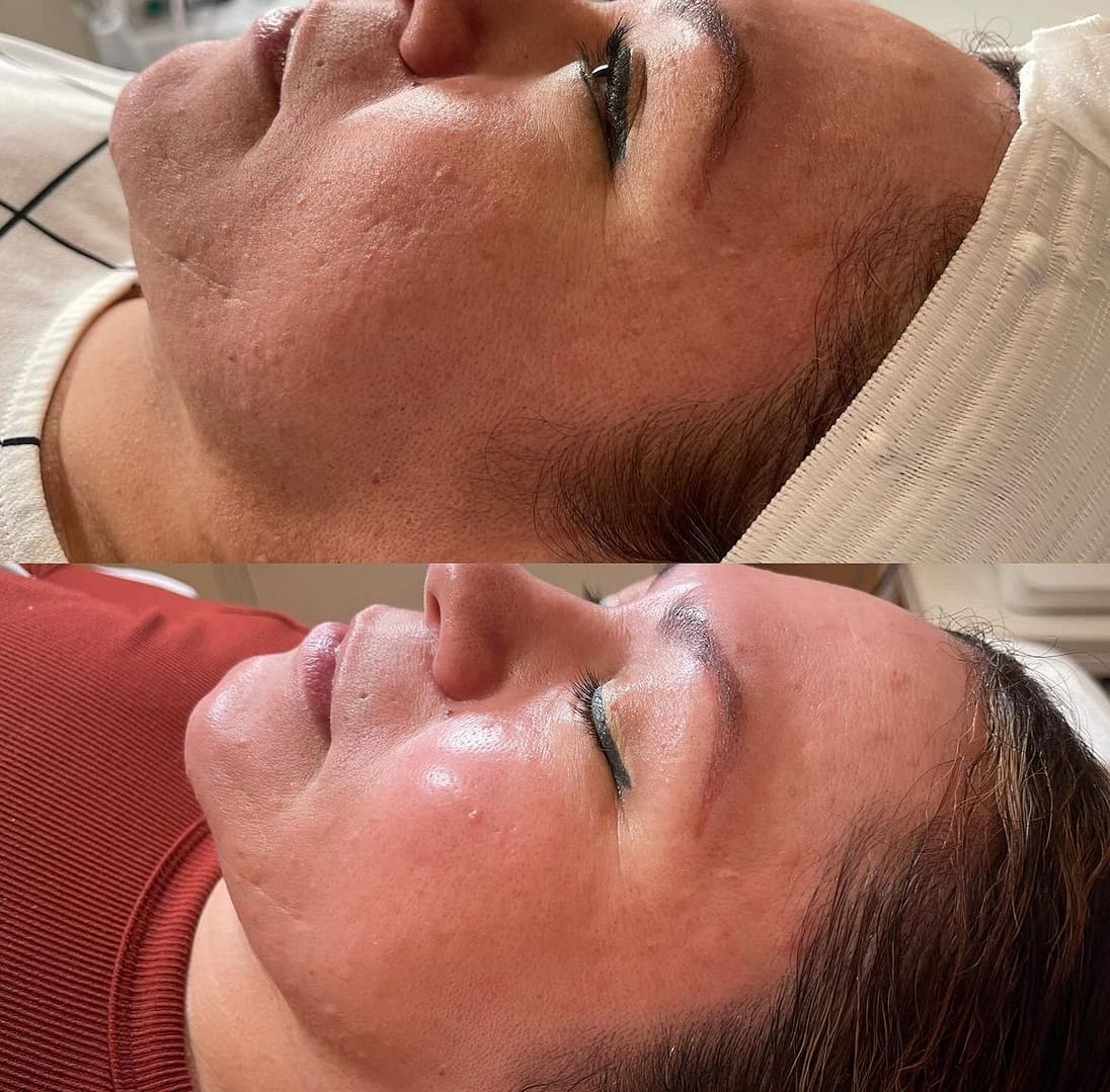 chemical peels at beverly wilshire aesthetics