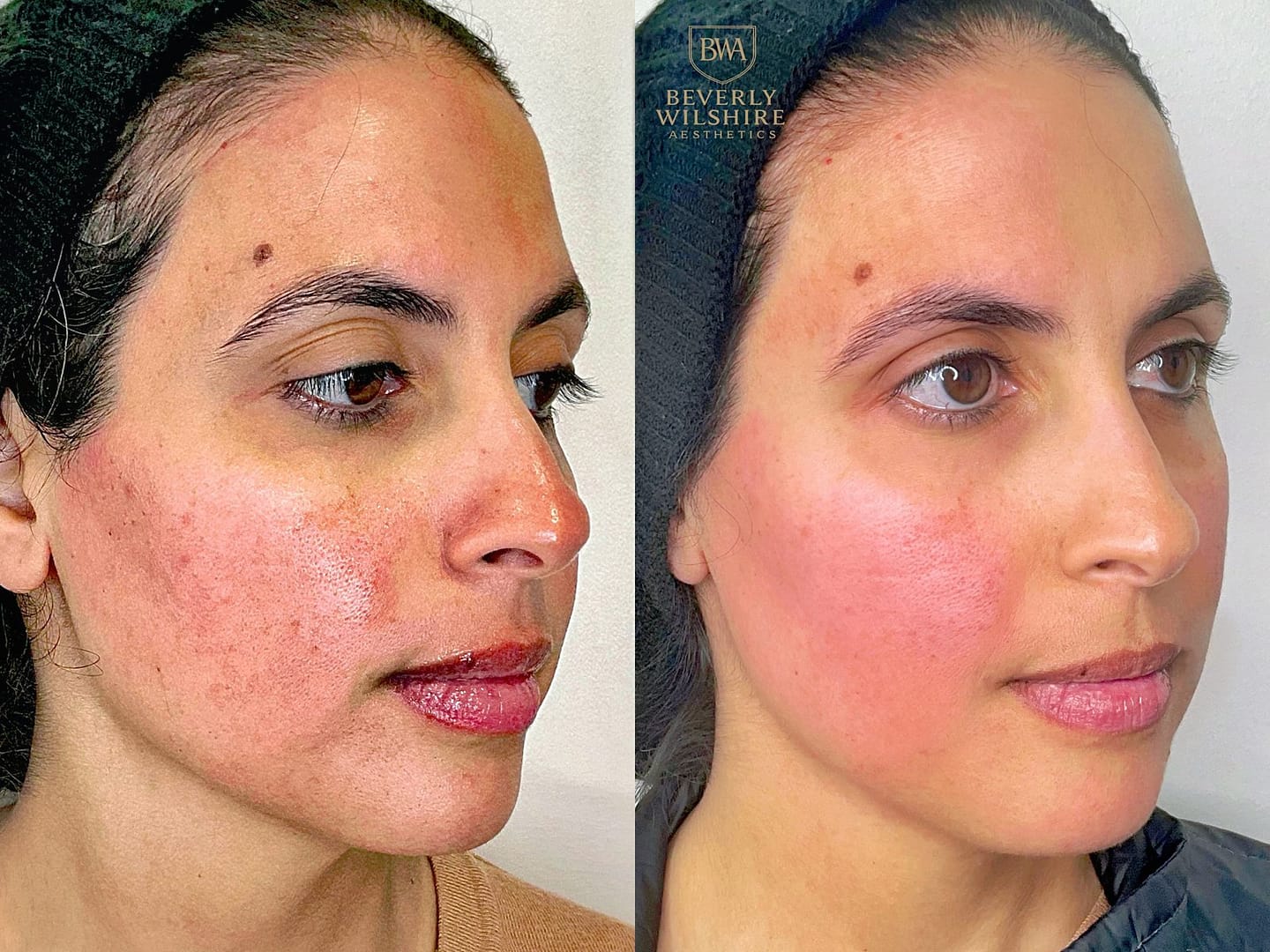 Microneedling image featuring before and after results