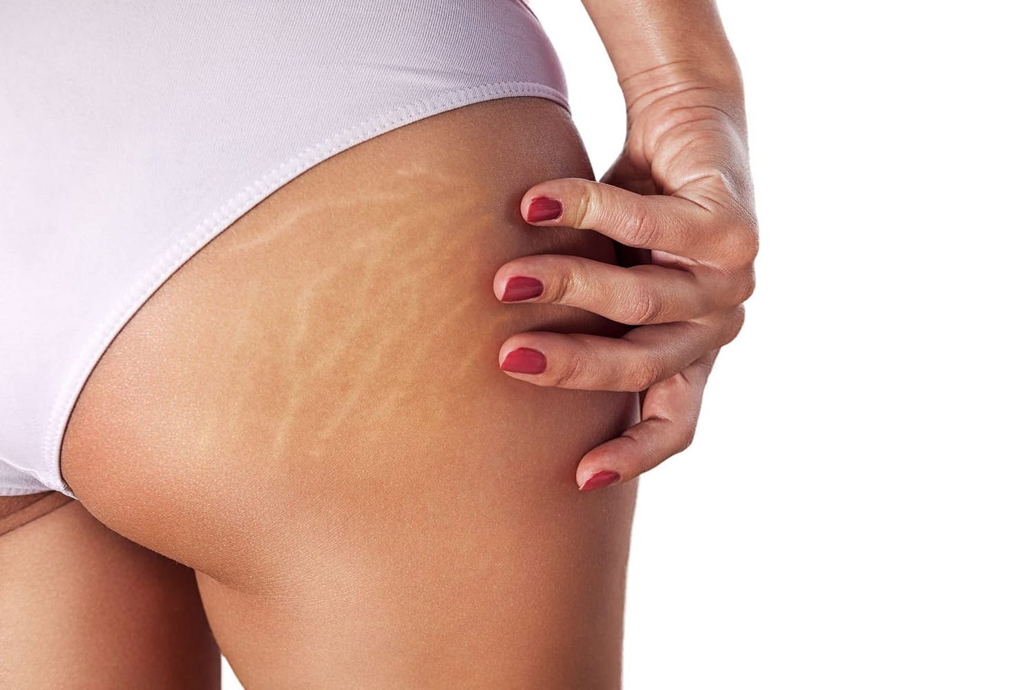 How To Get Rid Of Stretch Marks
