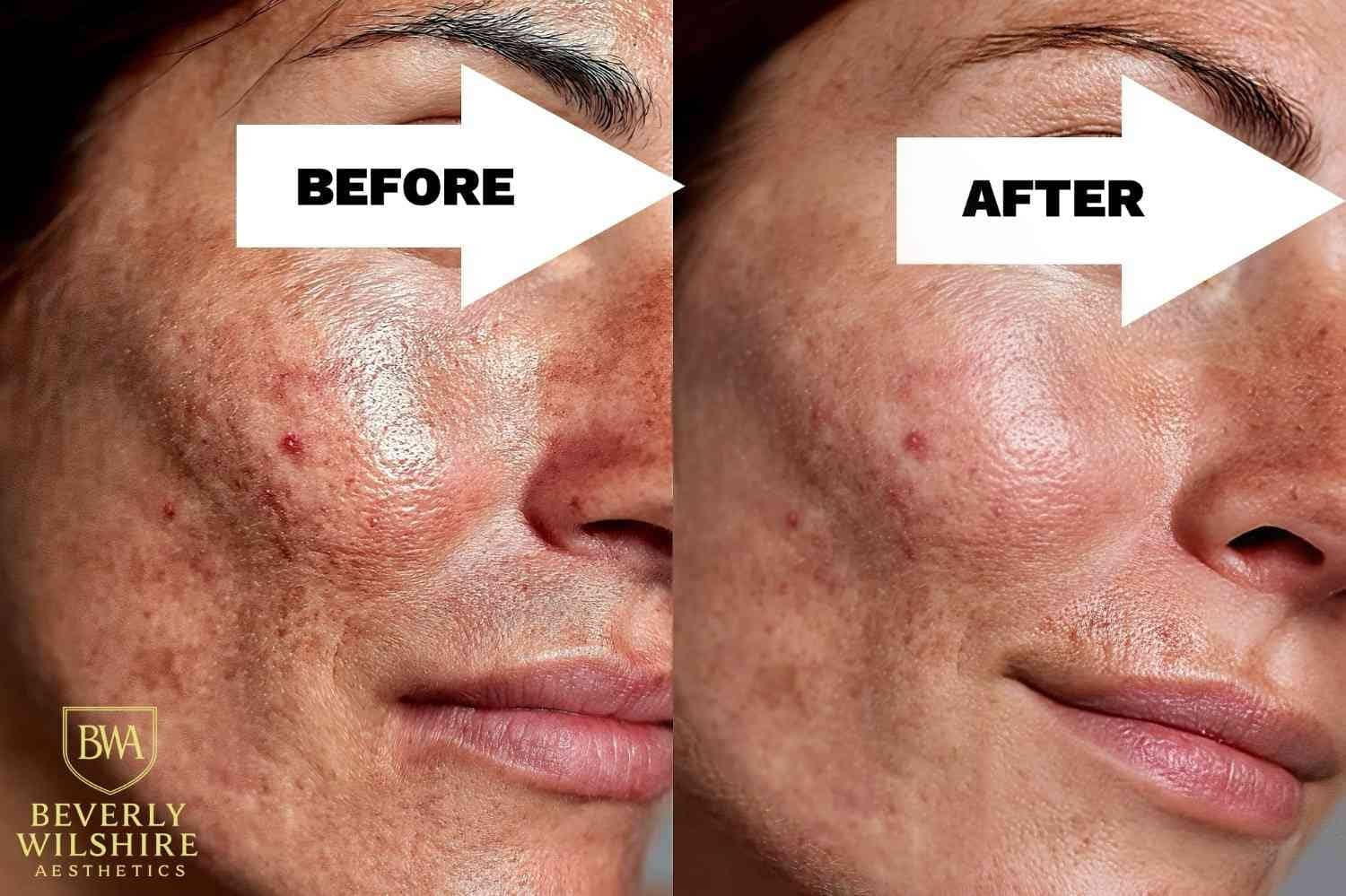 Before and After Results of Microneedling with Exosomes in Beverly Hills