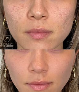 Microneedling Before and After