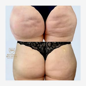 morpheus8 stretch-marks before after