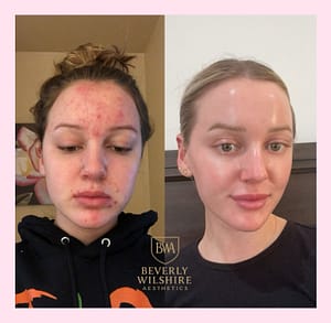 morpheus8 acne scar treatment before after.jpg