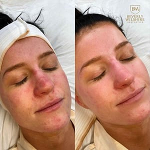 HydraFacial in Beverly Hills at BWA