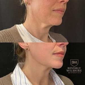 microneedling before and after results when paired with laser skin therapy