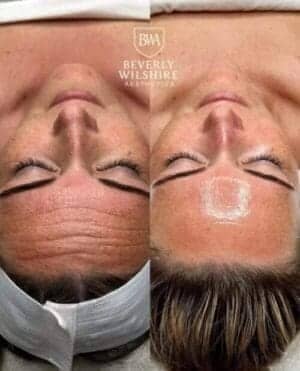 rf microneedling results in Beverly Hills at beverly wilshire aesthetics luxury med spa