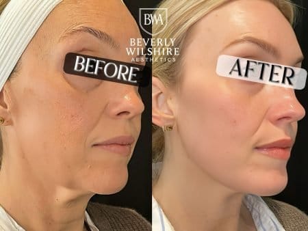 RF Microneedling Before and After results by Beverly Wilshire Aesthetics