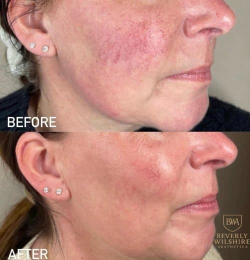IPL on face before and after