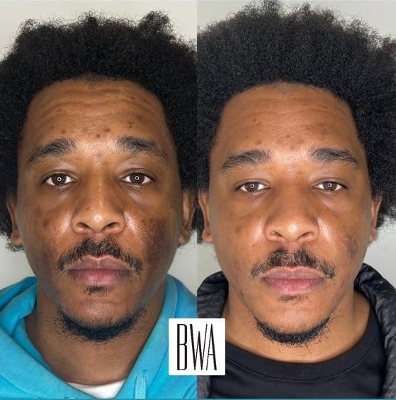 results from vi peel chemical peel before and after