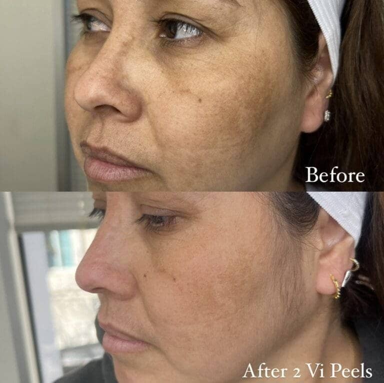 vi peel before and after results