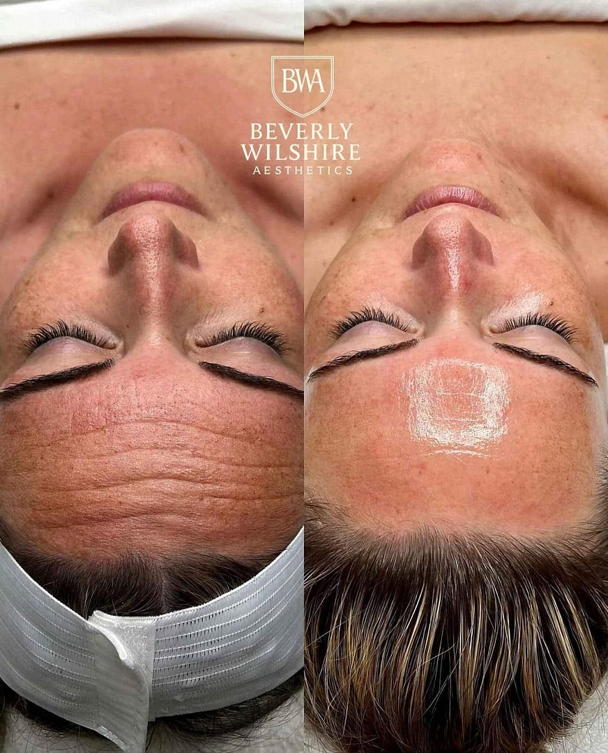 HydraFacial in Beverly Hills at BWA