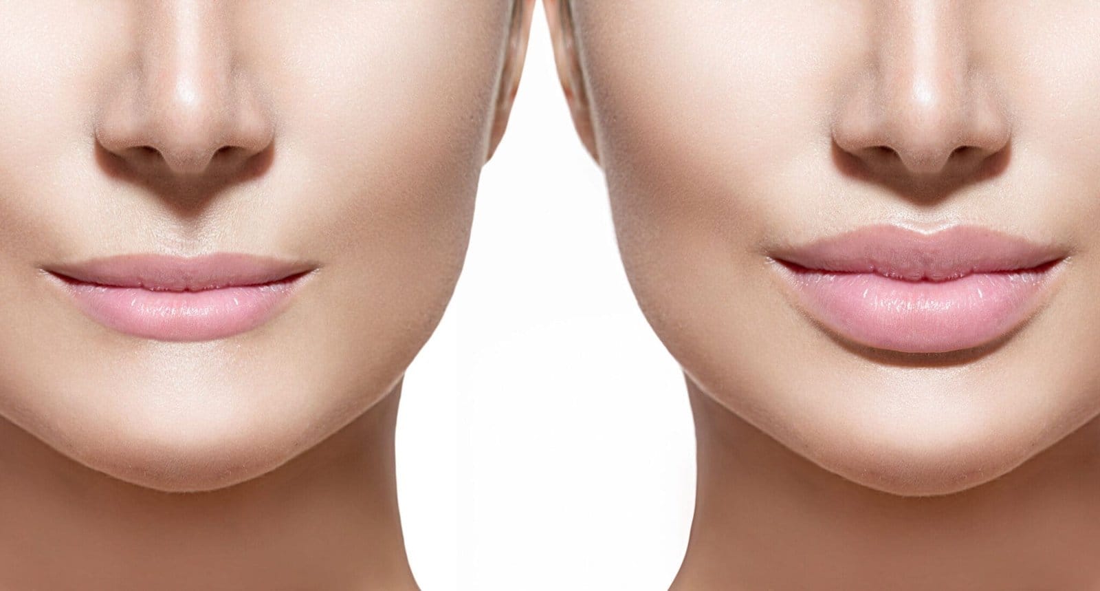 Lip Fillers Before and After