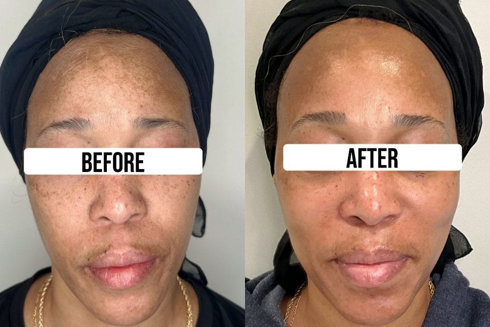 Client Results from BWA Halo HydraFacial Protocol 1 e1773053150910