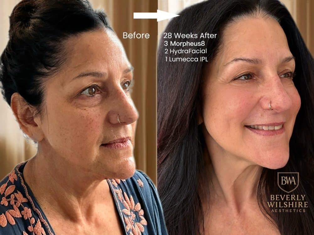 SupremeSkinPlanRealResults e1772712825822