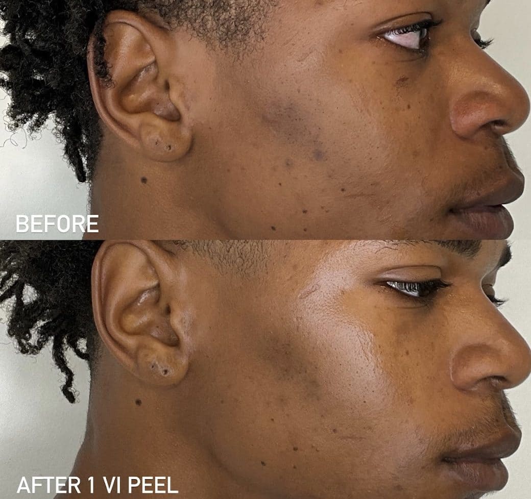 vi peel results e1770843910109