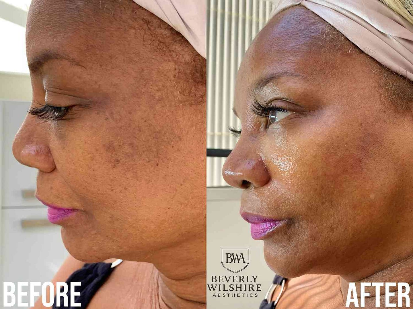 HydraFacial MD Results with Tyler the BWA Skin Savant