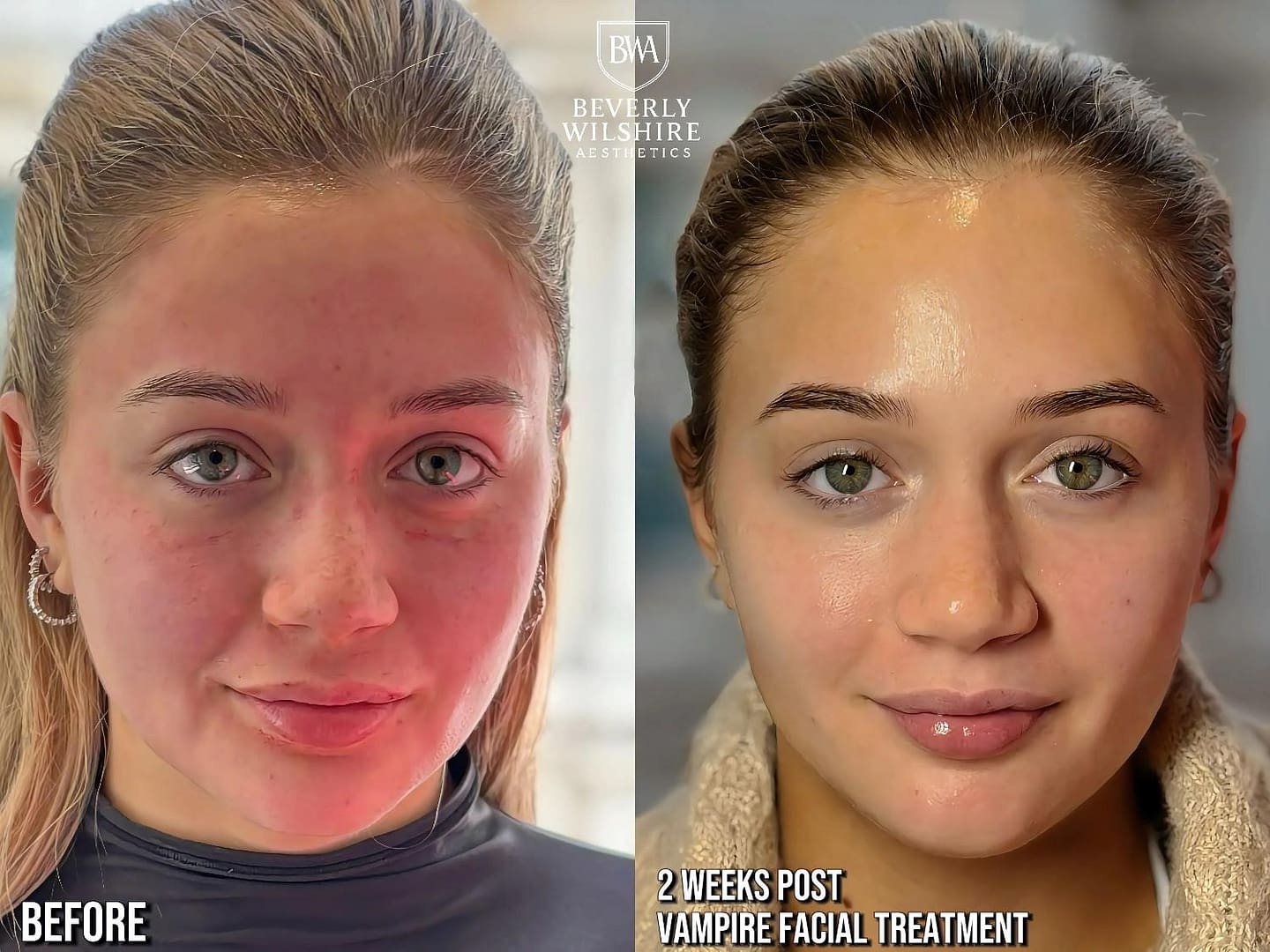 Vampire Facial Results Beverly Hills