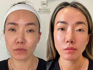 Client of Beverly Wilshire Aesthetics featured before and after work over the course of 12 months of Supreme Skin™ treatments to reveal her fully Ascended Skin.