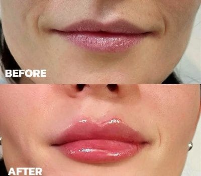 Beverly Hills Lip Filler e1773002116767