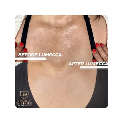 Lumecca Before and After Results