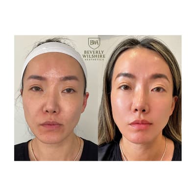 Beverly Wilshire Full Face Rejuvenation
