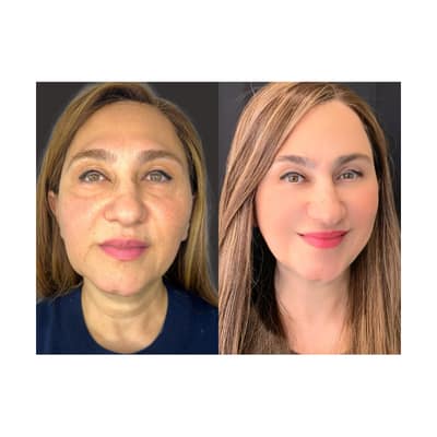 Beverly Wilshire's Supreme Skin™ Concept Results