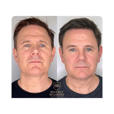 Male Morpheus8 results after 4 treatments