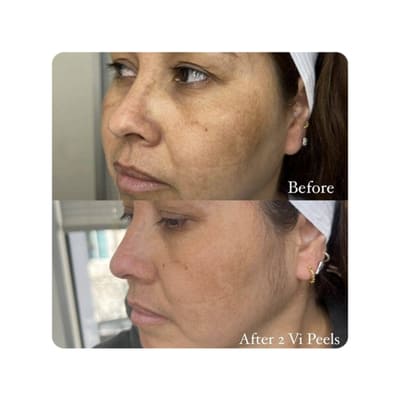 Vi Peel Chemical Peel Results