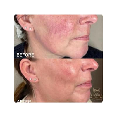 Lumecca IPL Treatment Results
