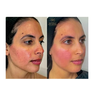 Chemical Peel Resurfacing Results