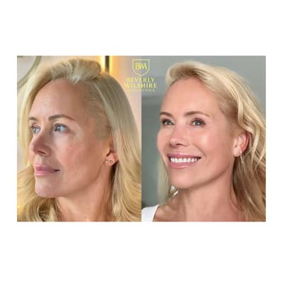 Results from 1 Lumecca IPL Treatment in Beverly Hills