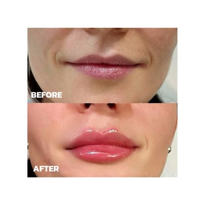 Lip Filler Results MD Precision Results