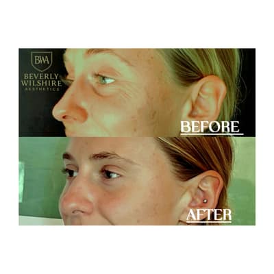 Botox and HydraFacial Combined Treatment Results