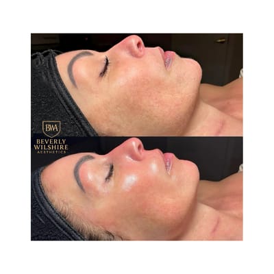 HydraFacial Series Results