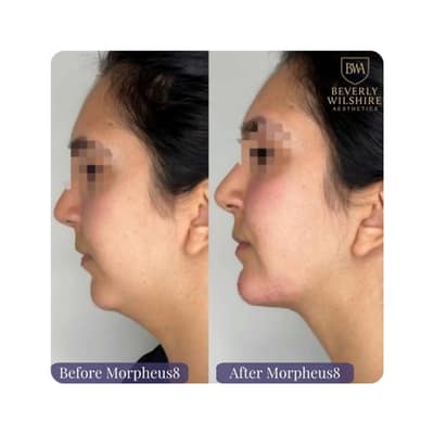 Morpheus8 and Dermal Fillers for Chin Volume and Definition