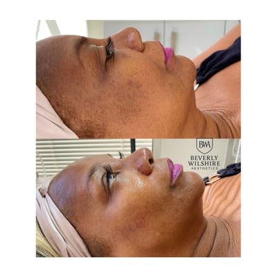 Botox and HydraFiller core treatments at BWA