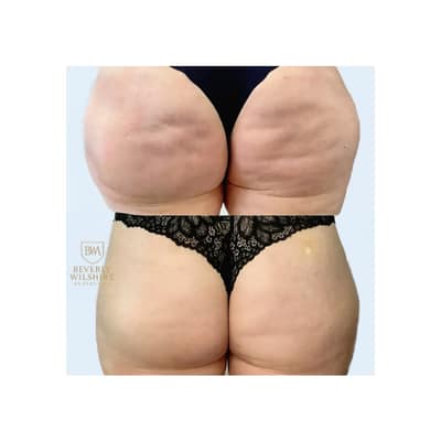 Morpheus8 Buttock Results from 3 Sessions