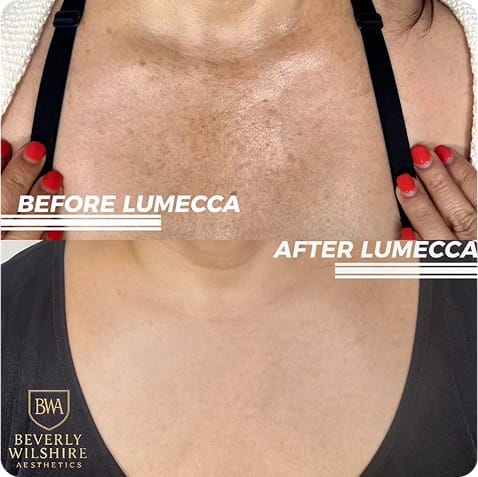 Lumecca IPL Sun Damage Beverly Hills