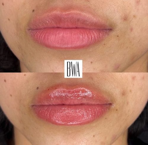 BWA Lip Filler Beverly Hills Results e1772906704451