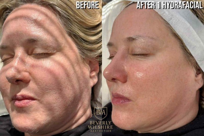 Halo HydraFacial Results with the Beverly Hills Skin Savant Tyler e1770842814405