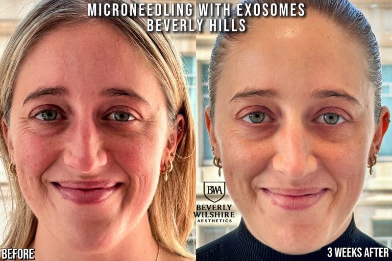 Best Microneedling with Exosomes Beverly Hills e1772480022311