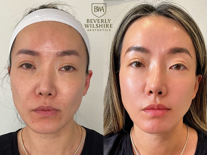 Client of Beverly Wilshire Aesthetics featured before and after work over the course of 12 months of Supreme Skin™ treatments to reveal her fully Ascended Skin.
